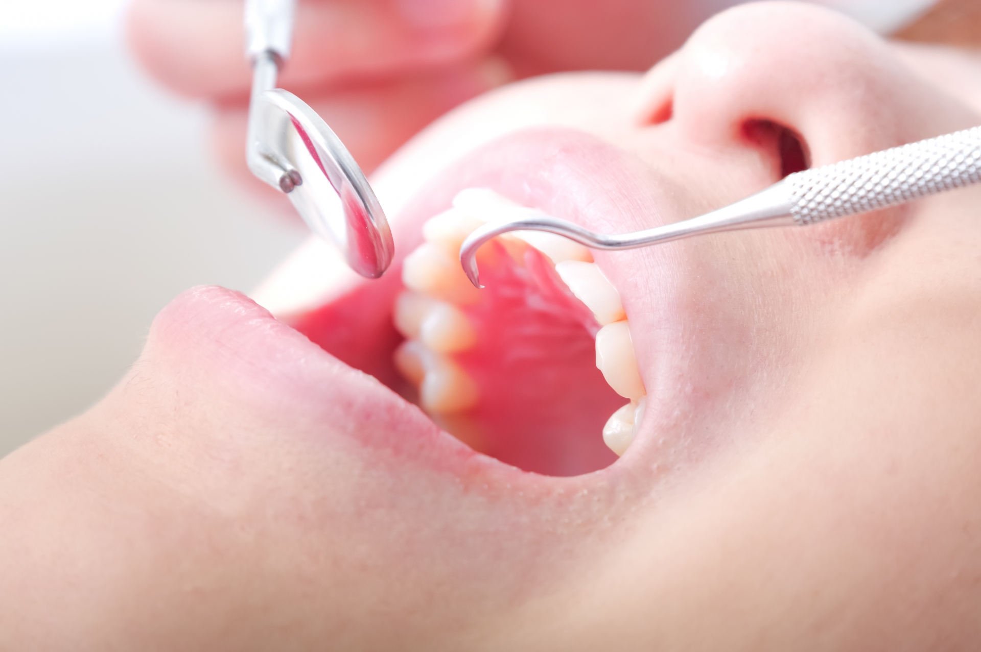 根管治療の説明画像