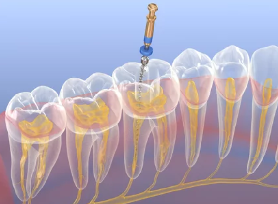 根管治療の説明画像