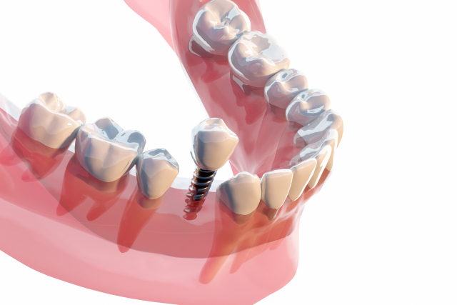 インプラント治療の説明画像