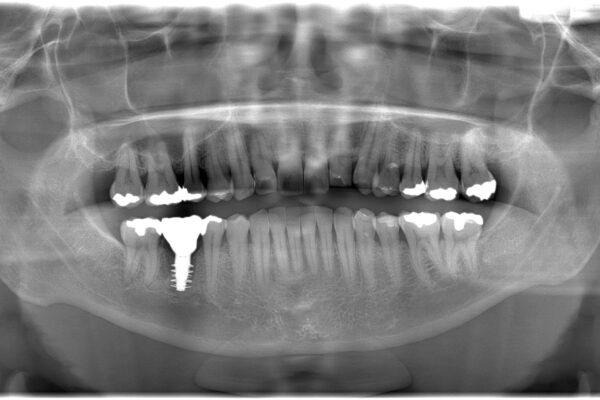 治療後